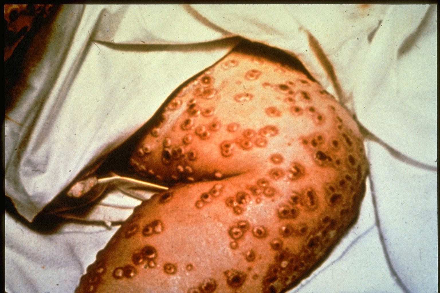 Smallpox Images | Immunize.org