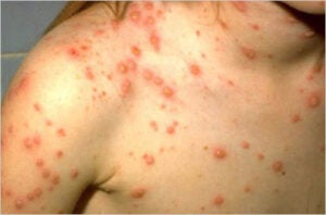 Varicella (Chickenpox) Images | Immunize.org